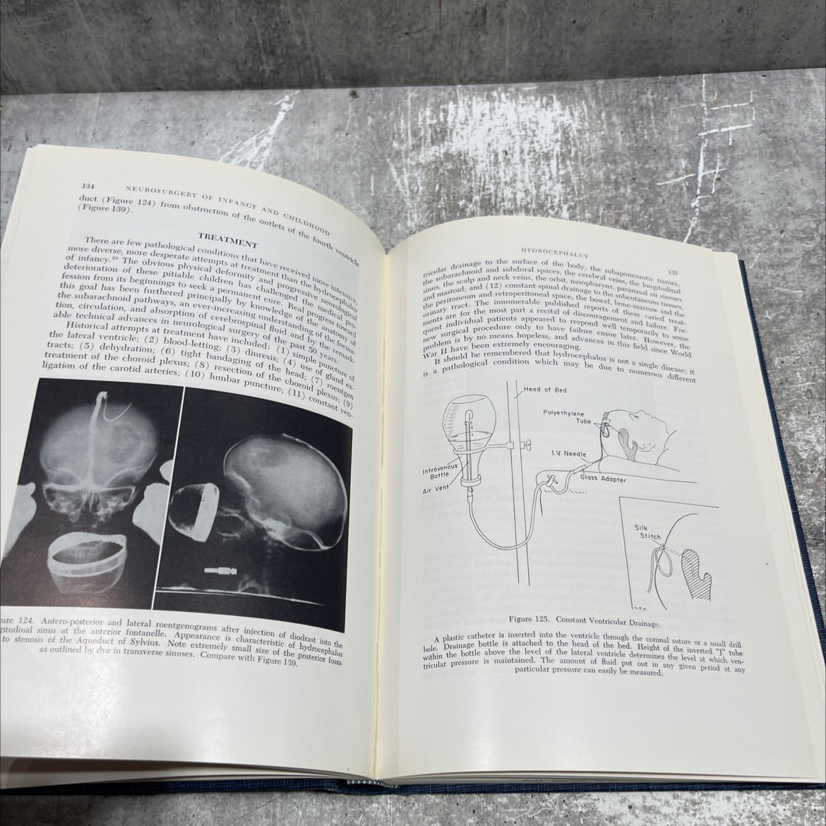 neurosurgery of infancy and childhood book, by franc d. ingraham, m.d., donald d. matson, m.d., 1961 Hardcover image 4