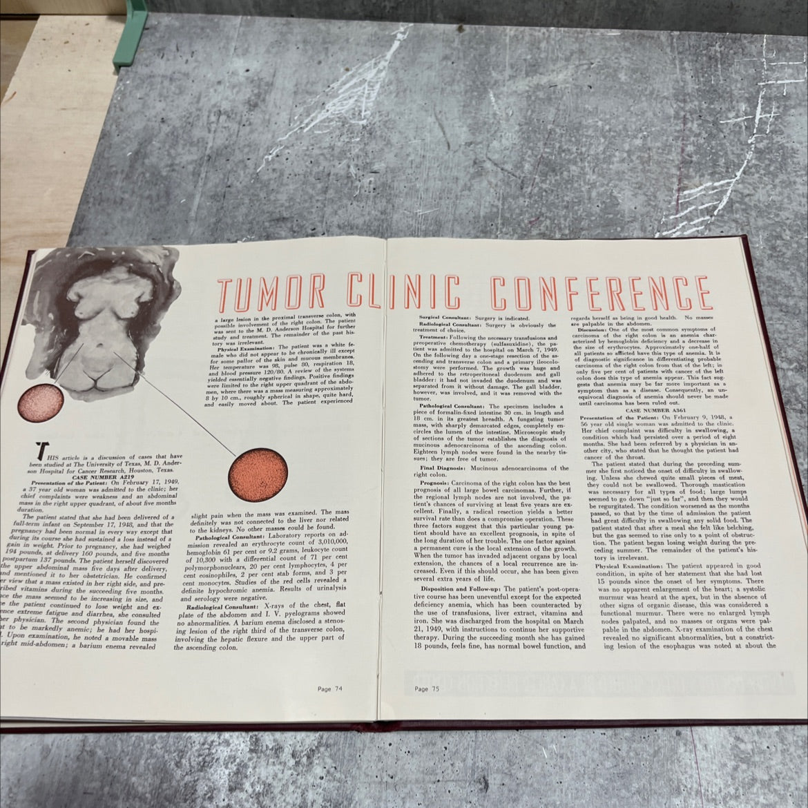 tumor topics book, by r. lee clark, jr., russell w. cumley, 1950 Hardcover image 4